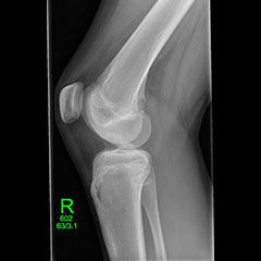 Adolescent knee pain