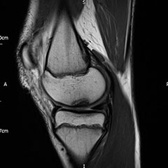 Adolescent knee pain