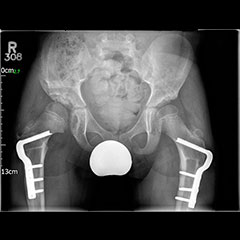 Dysplastic hips on child - after