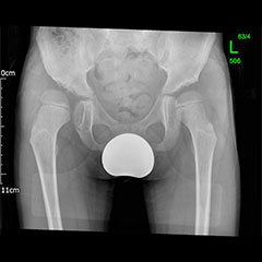 Dysplastic hips on child - before