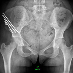 Hip preservation - after