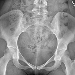 Hip preservation - before